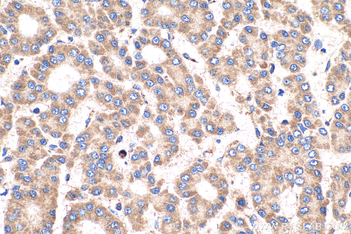 Immunohistochemical analysis of paraffin-embedded human liver cancer tissue slide using KHC0394 (AIMP2/JTV1 IHC Kit).