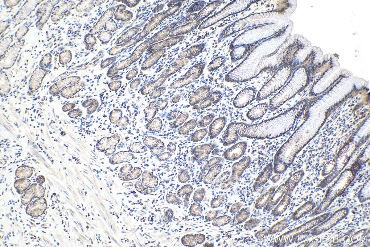 Immunohistochemical analysis of paraffin-embedded human stomach cancer tissue slide using KHC0993 (AIP IHC Kit).
