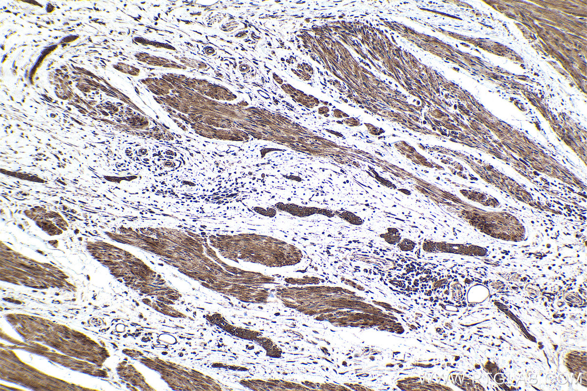 Immunohistochemical analysis of paraffin-embedded human urothelial carcinoma tissue slide using KHC1691 (AKAP13 IHC Kit).