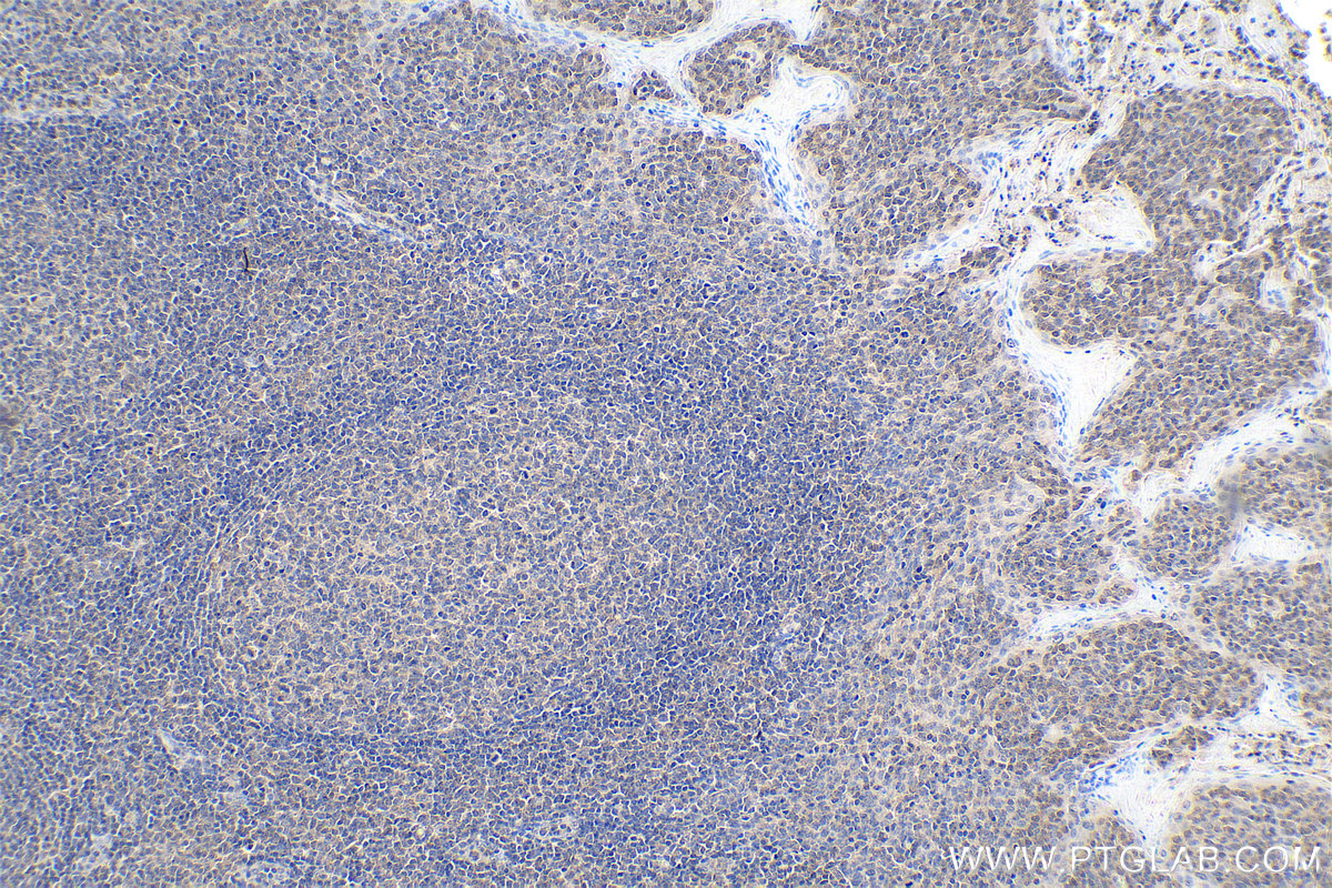 Immunohistochemical analysis of paraffin-embedded human tonsillitis tissue slide using KHC0115 (AKT IHC Kit).