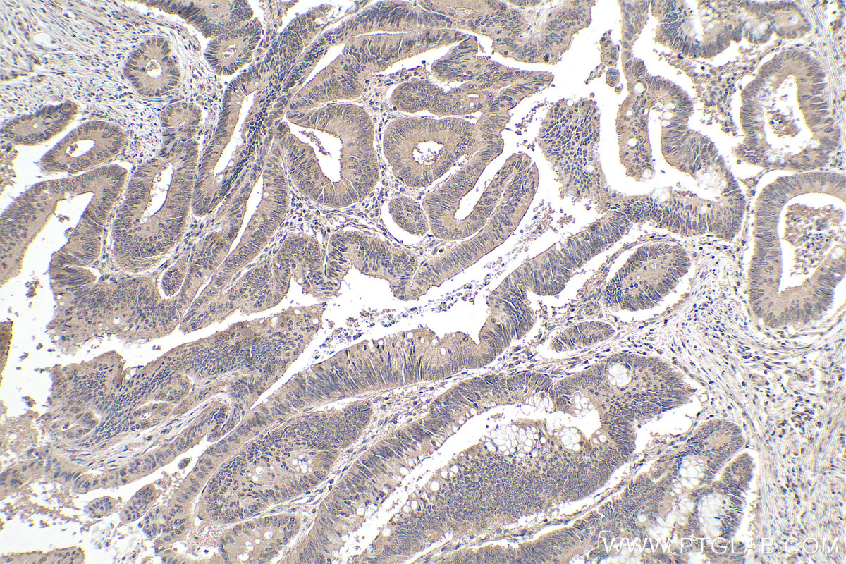 Immunohistochemical analysis of paraffin-embedded human colon cancer tissue slide using KHC0115 (AKT IHC Kit).