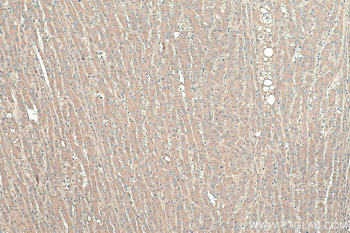 Immunohistochemical analysis of paraffin-embedded human liver cancer tissue slide using KHC0376 (ALB IHC Kit).