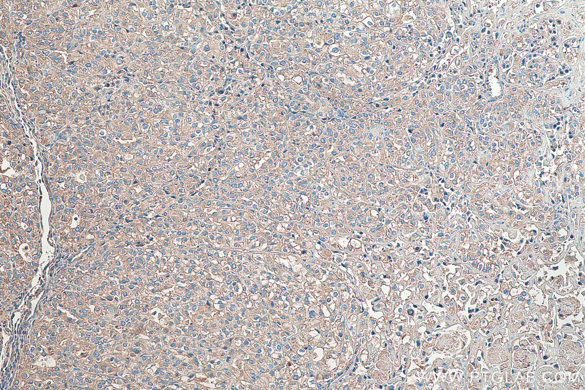 Immunohistochemical analysis of paraffin-embedded human endometrial cancer tissue slide using KHC0376 (ALB IHC Kit).