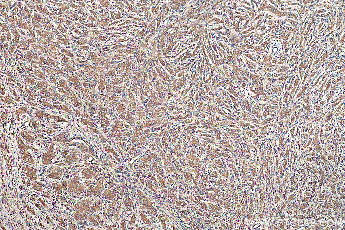 Immunohistochemical analysis of paraffin-embedded human prostate cancer tissue slide using KHC0216 (ALDH1A2 IHC Kit).