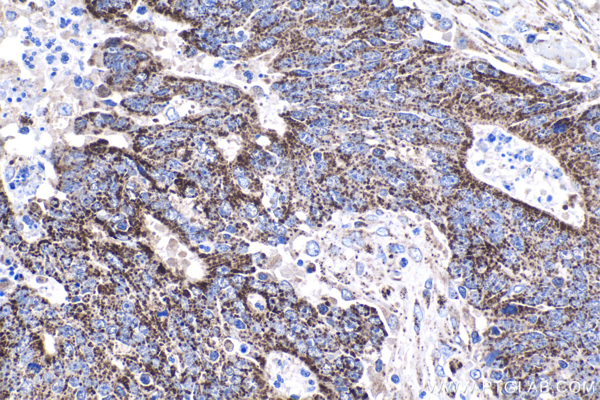Immunohistochemical analysis of paraffin-embedded human colon cancer tissue slide using KHC1045 (ALDH1B1 IHC Kit).