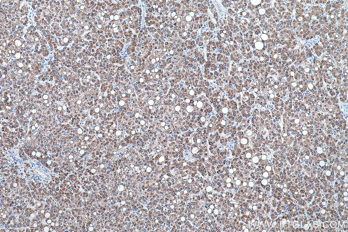 Immunohistochemical analysis of paraffin-embedded human liver cancer tissue slide using KHC0506 (ALDH2 IHC Kit).