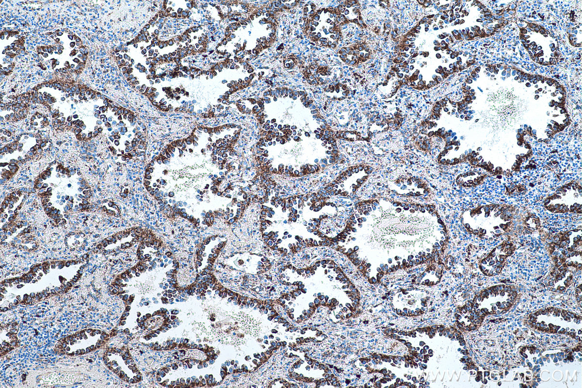 Immunohistochemical analysis of paraffin-embedded human lung cancer tissue slide using KHC0506 (ALDH2 IHC Kit).