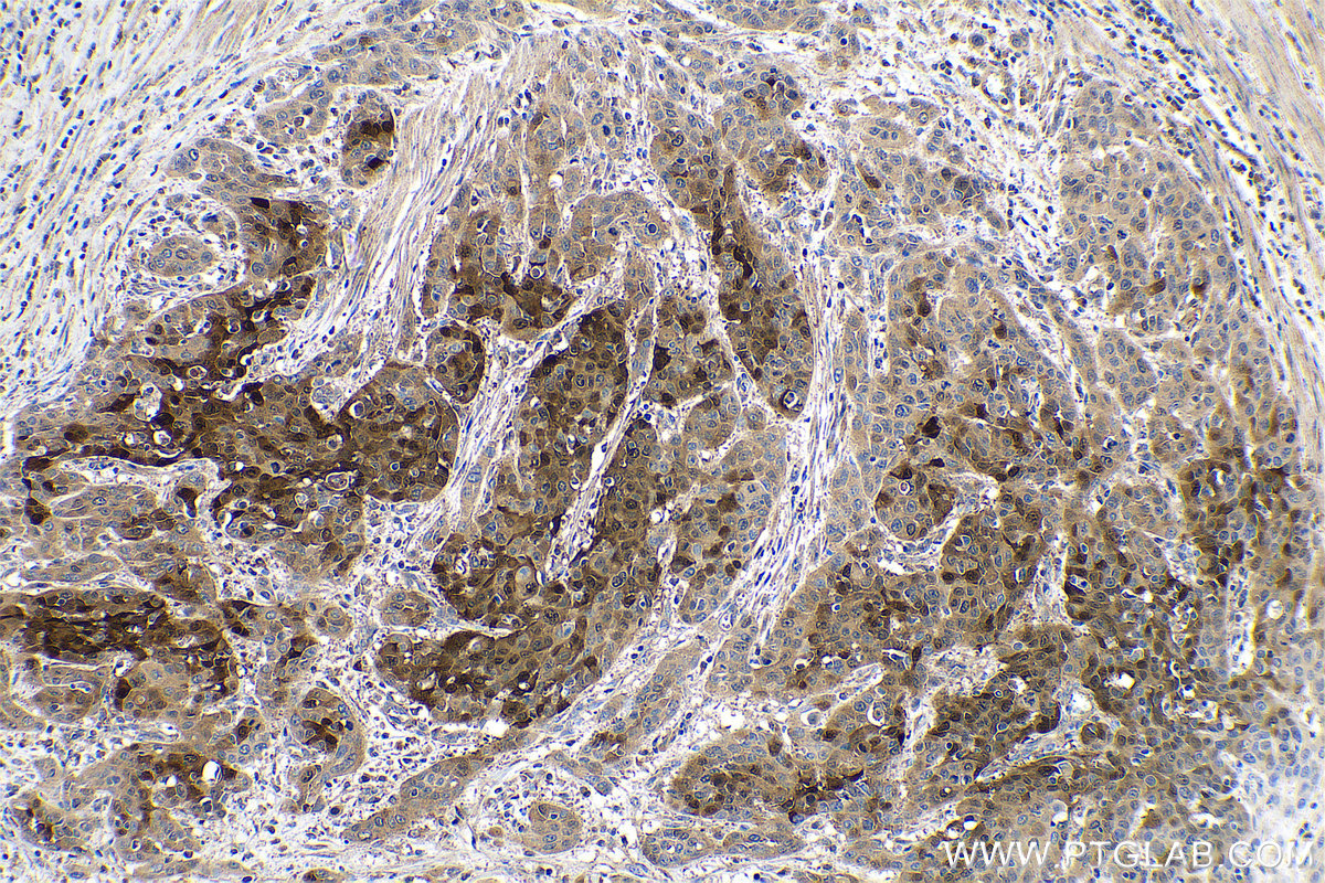 Immunohistochemical analysis of paraffin-embedded human oesophagus cancer tissue slide using KHC0690 (ALDH3A1 IHC Kit).