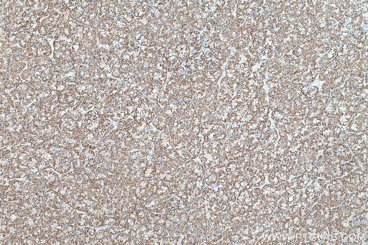 Immunohistochemical analysis of paraffin-embedded human liver cancer tissue slide using KHC0525 (ALDH4A1 IHC Kit).