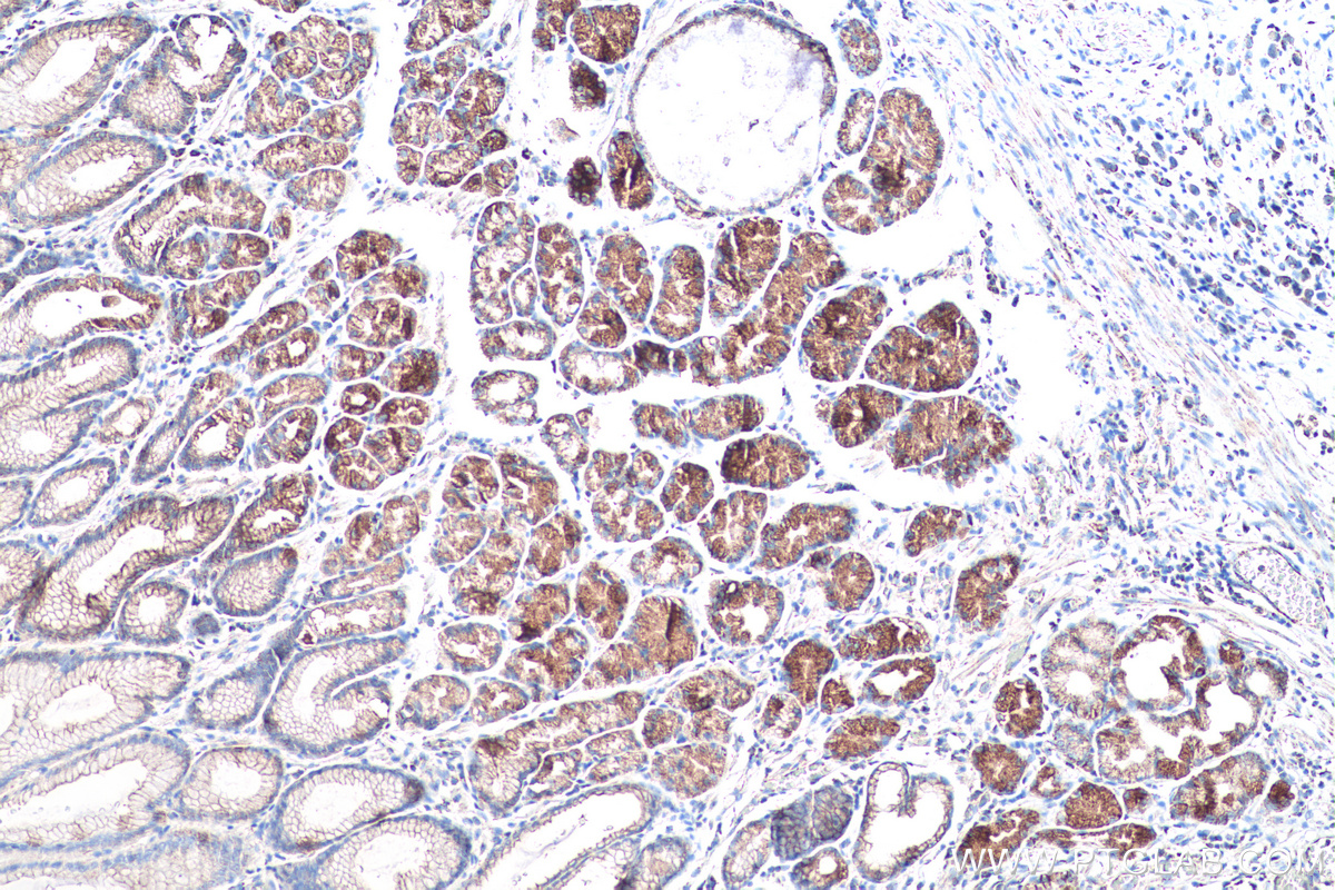 Immunohistochemical analysis of paraffin-embedded human stomach cancer(NAT) tissue slide using KHC0545 (ALDH6A1 IHC Kit).