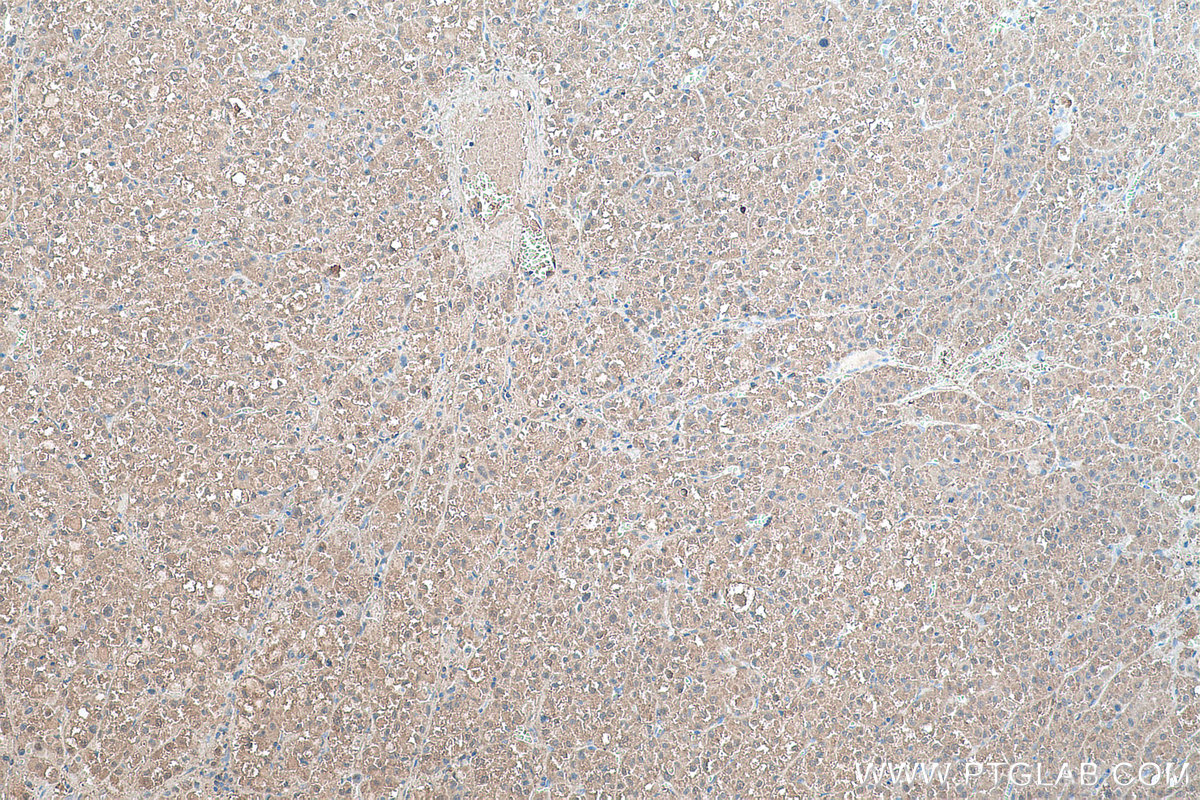 Immunohistochemical analysis of paraffin-embedded human liver cancer tissue slide using KHC0488 (ALDOA IHC Kit).