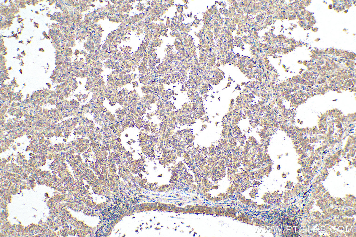 Immunohistochemical analysis of paraffin-embedded human lung cancer tissue slide using KHC0873 (ALIX IHC Kit).