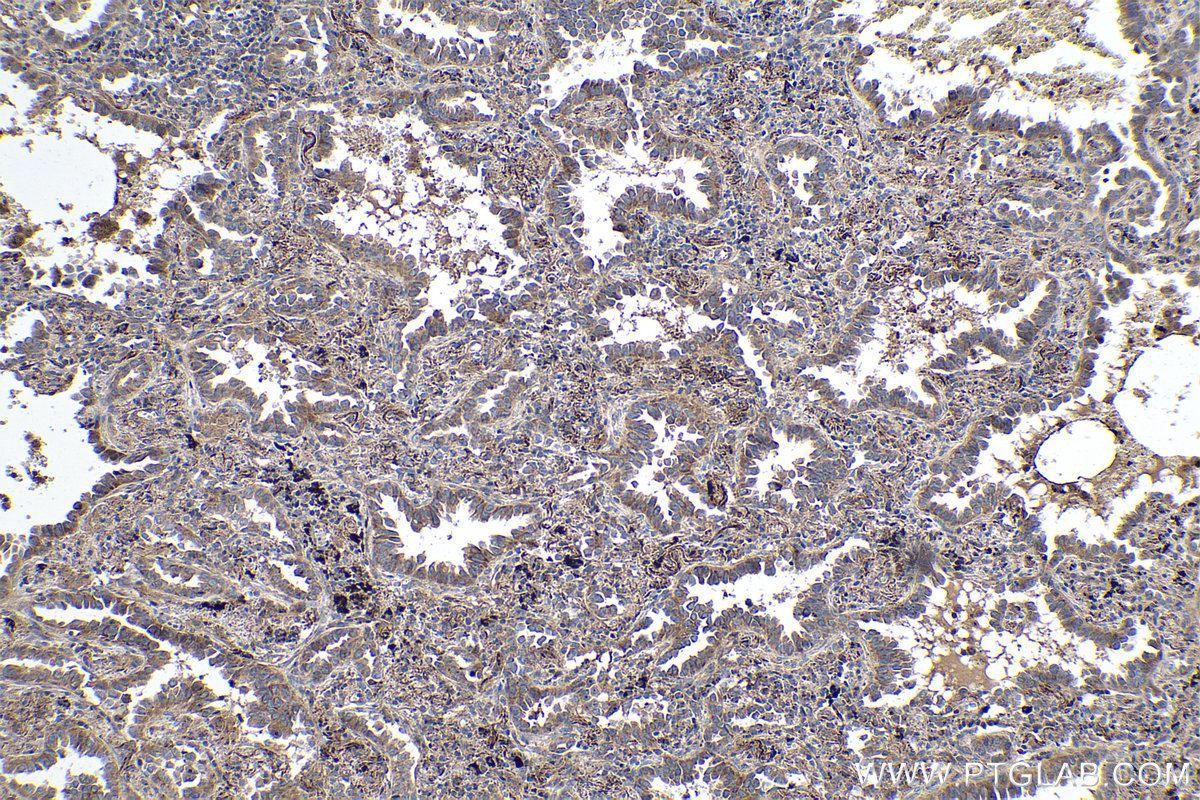 Immunohistochemical analysis of paraffin-embedded human lung cancer tissue slide using KHC0180 (ALKBH3 IHC Kit).