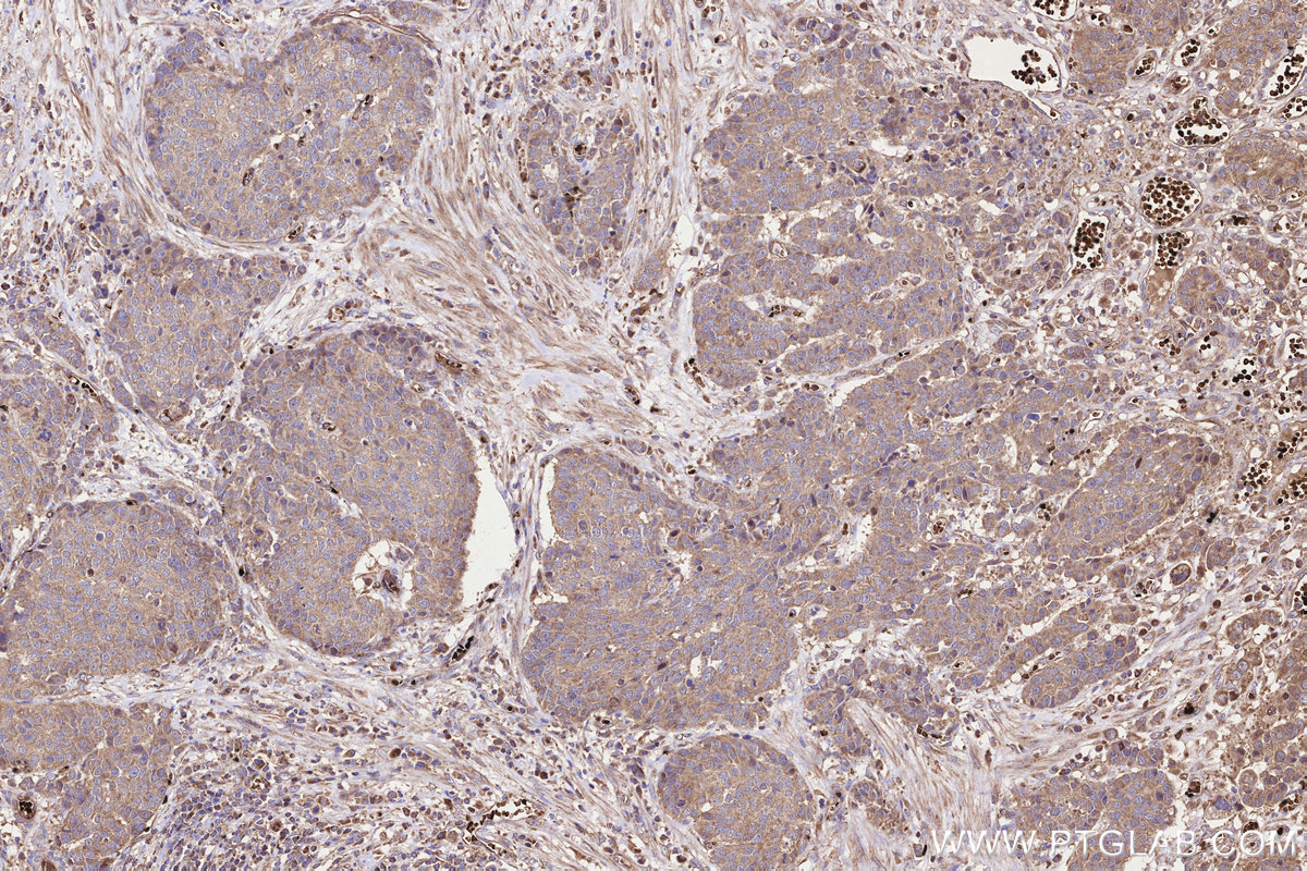 Immunohistochemical analysis of paraffin-embedded human stomach cancer tissue slide using KHC3231 (ALR IHC Kit).