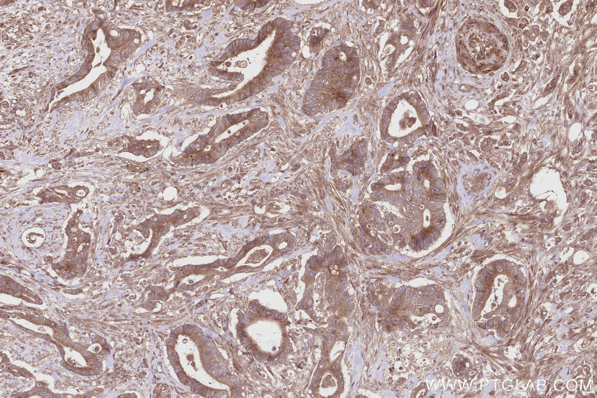 Immunohistochemical analysis of paraffin-embedded human rectal cancer tissue slide using KHC2819 (ALS2 IHC Kit).