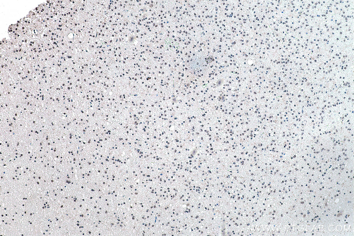 Immunohistochemical analysis of paraffin-embedded human gliomas tissue slide using KHC0175 (ALY IHC Kit).