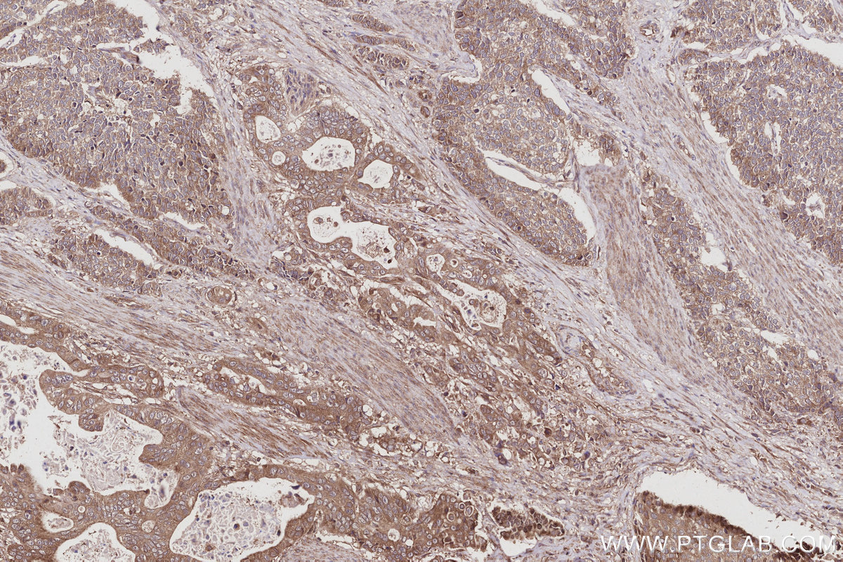 Immunohistochemical analysis of paraffin-embedded human stomach cancer tissue slide using KHC3030 (AMFR/GP78 IHC Kit).