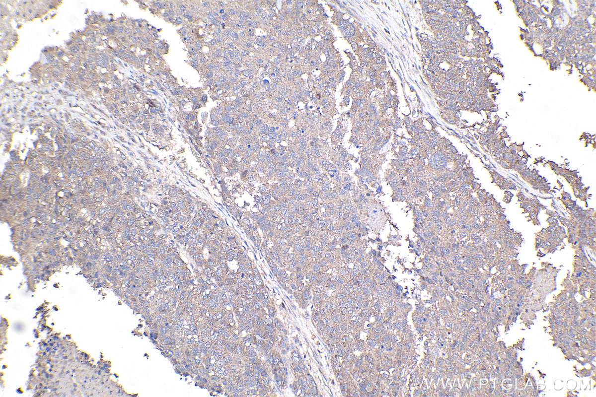 Immunohistochemical analysis of paraffin-embedded human ovary cancer tissue slide using KHC2108 (ANKRD17 IHC Kit).