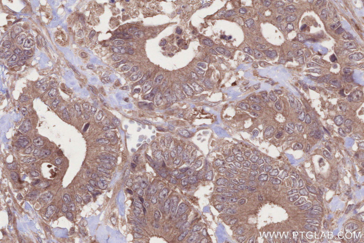 Immunohistochemical analysis of paraffin-embedded human rectal cancer tissue slide using KHC2682 (ANKRD53 IHC Kit).
