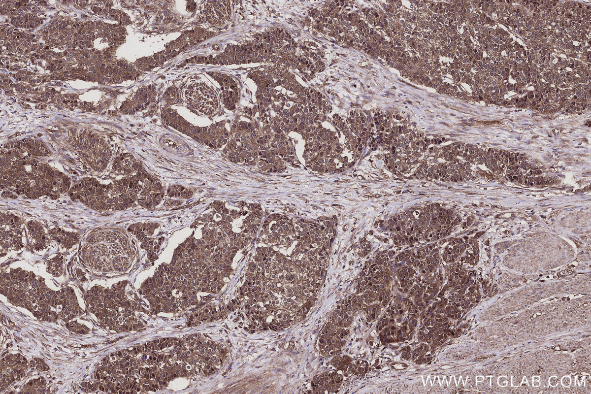 Immunohistochemical analysis of paraffin-embedded human stomach cancer tissue slide using KHC3104 (ANKRD54 IHC Kit). Immunohistochemical analysis of paraffin-embedded human stomach cancer tissue slide using KHC3104 (ANKRD54 IHC Kit).