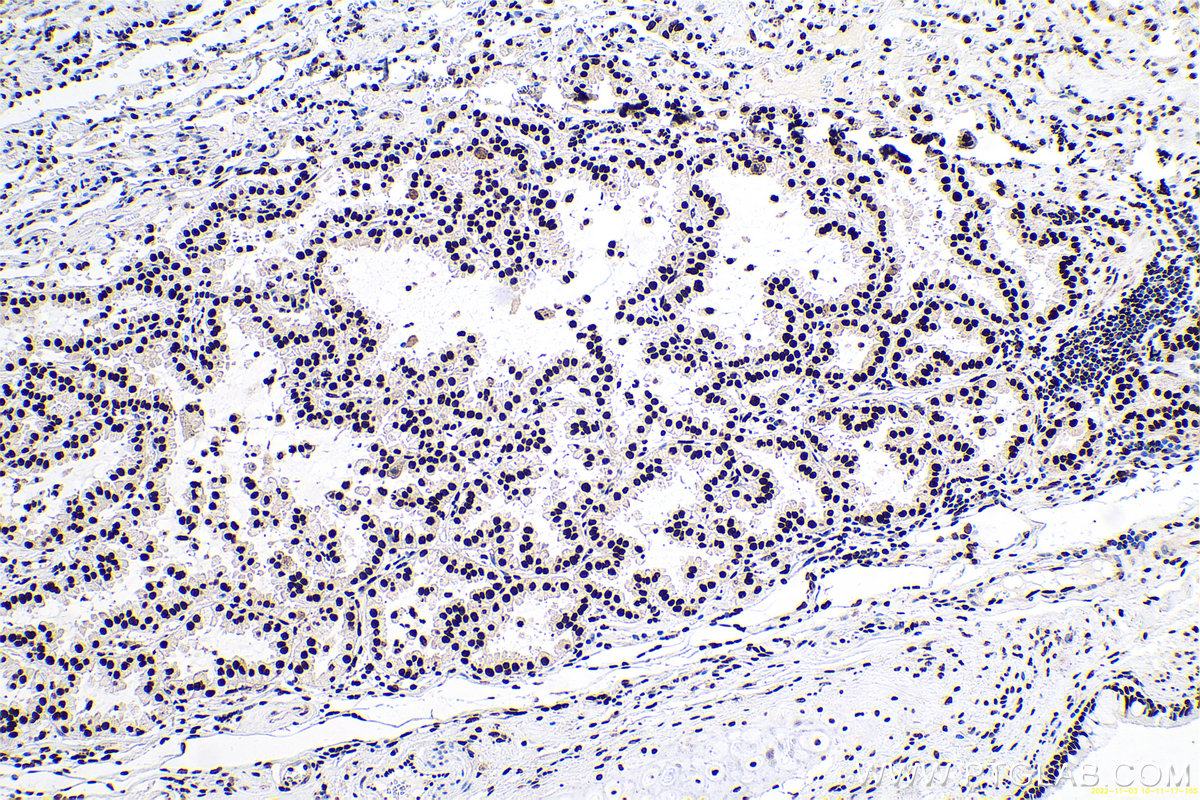 Immunohistochemical analysis of paraffin-embedded human lung cancer tissue slide using KHC0670 (ANP32A IHC Kit).