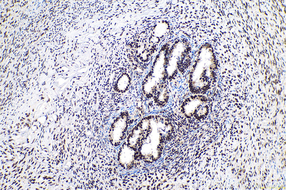 Immunohistochemical analysis of paraffin-embedded human ovary tumor tissue slide using KHC0670 (ANP32A IHC Kit).