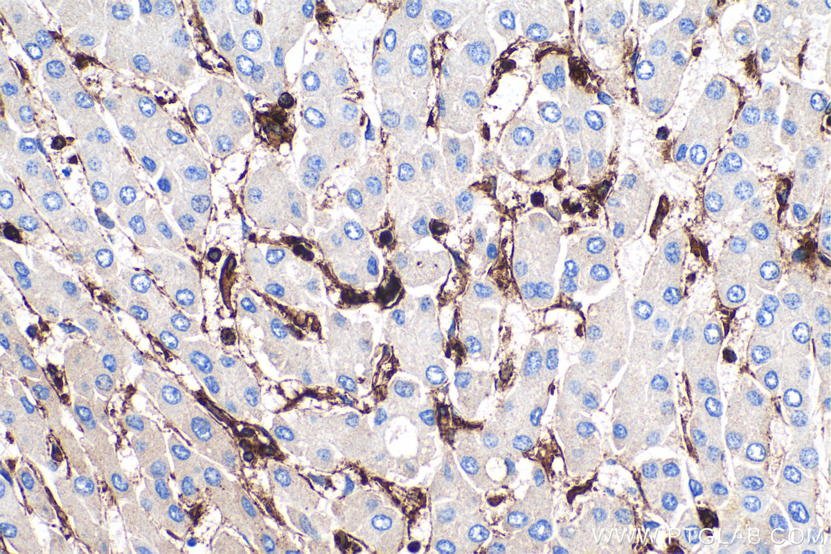 Immunohistochemical analysis of paraffin-embedded human liver cancer tissue slide using KHC0399 (ANXA1 IHC Kit).