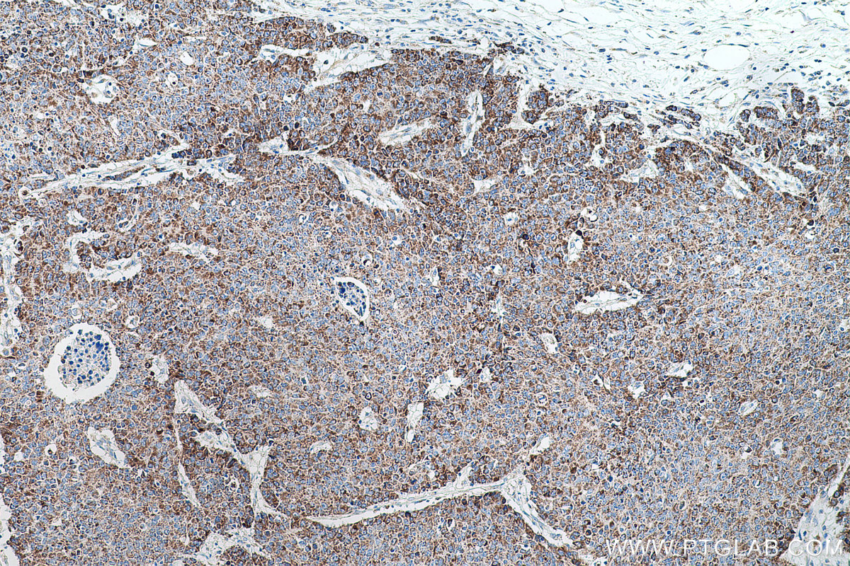 Immunohistochemical analysis of paraffin-embedded human colon cancer tissue slide using KHC0692 (ANXA10 IHC Kit).