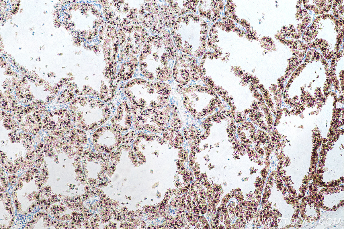 Immunohistochemical analysis of paraffin-embedded human lung cancer tissue slide using KHC0692 (ANXA10 IHC Kit).