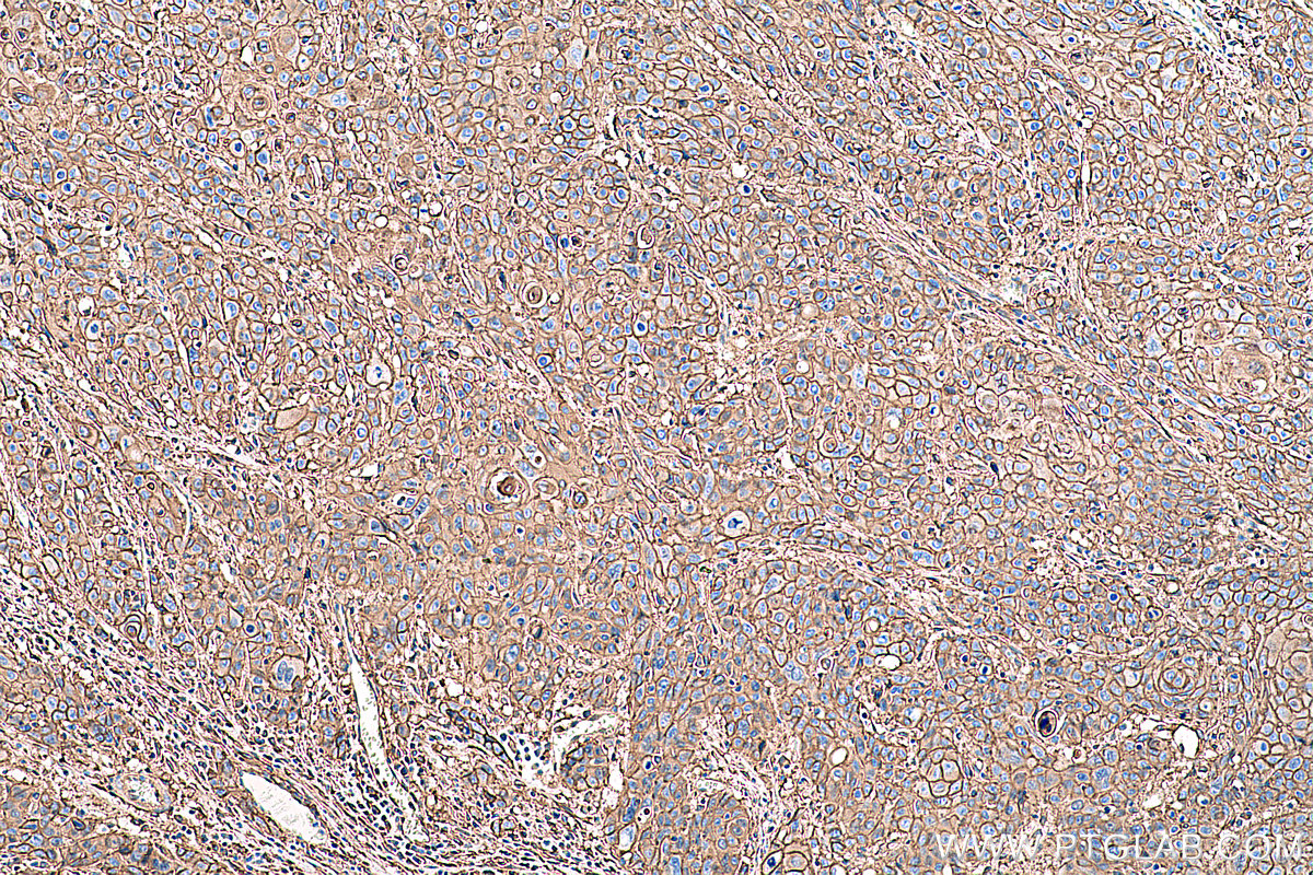 Immunohistochemical analysis of paraffin-embedded human oesophagus cancer tissue slide using KHC0396 (ANXA2 IHC Kit).