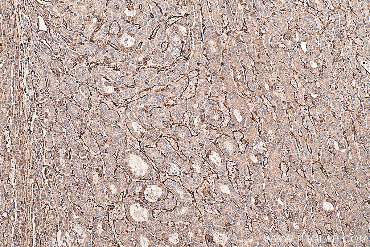 Immunohistochemical analysis of paraffin-embedded human liver cancer tissue slide using KHC0396 (ANXA2 IHC Kit).