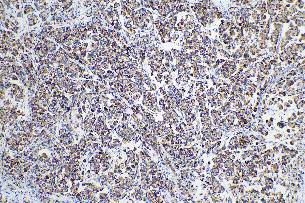 Immunohistochemical analysis of paraffin-embedded human colon cancer tissue slide using KHC0706 (ANXA3 IHC Kit).