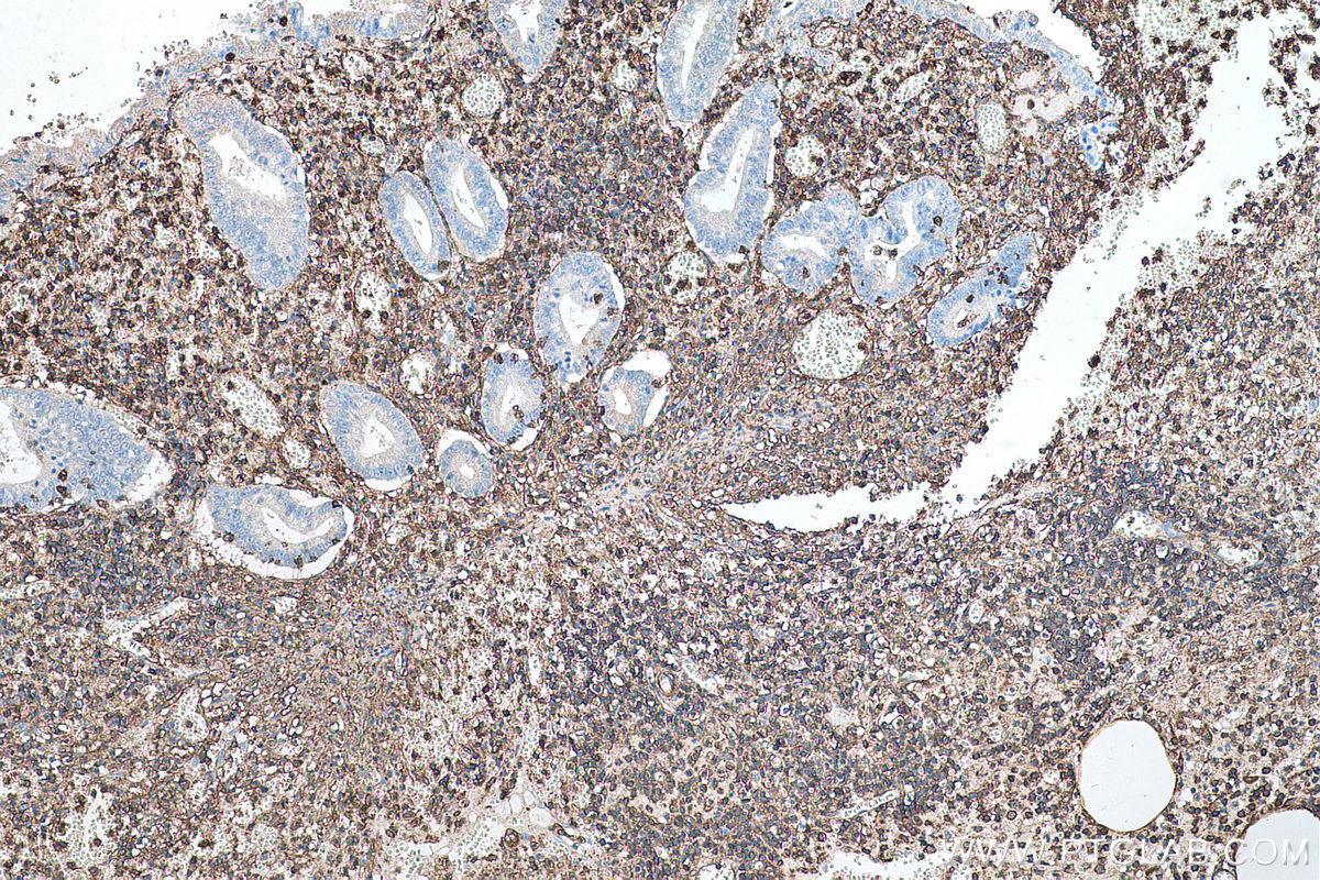 Immunohistochemical analysis of paraffin-embedded human appendicitis tissue slide using KHC0561 (ANXA6 IHC Kit).