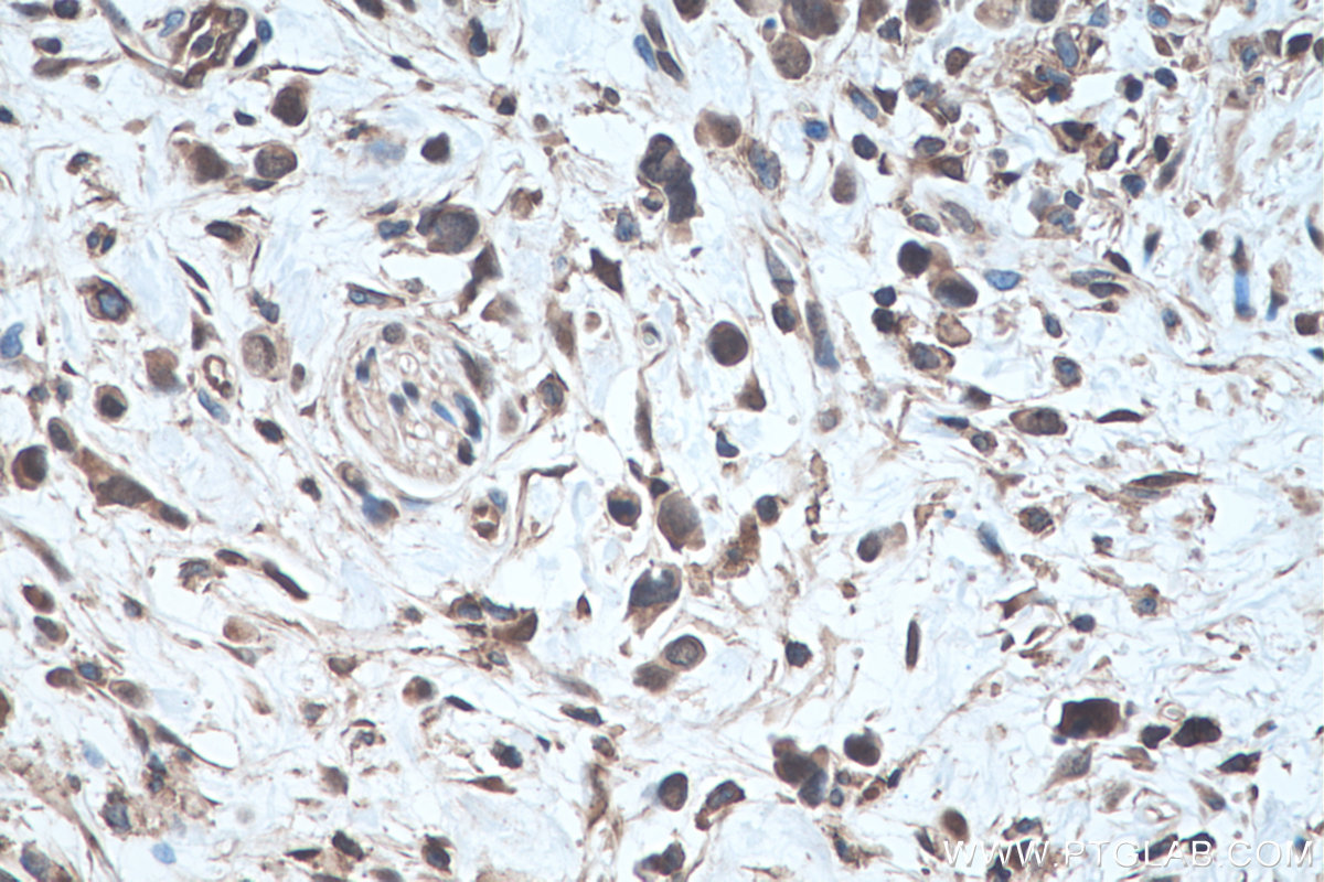 Immunohistochemical analysis of paraffin-embedded human stomach cancer tissue slide using KHC0281 (ANXA7 IHC Kit).