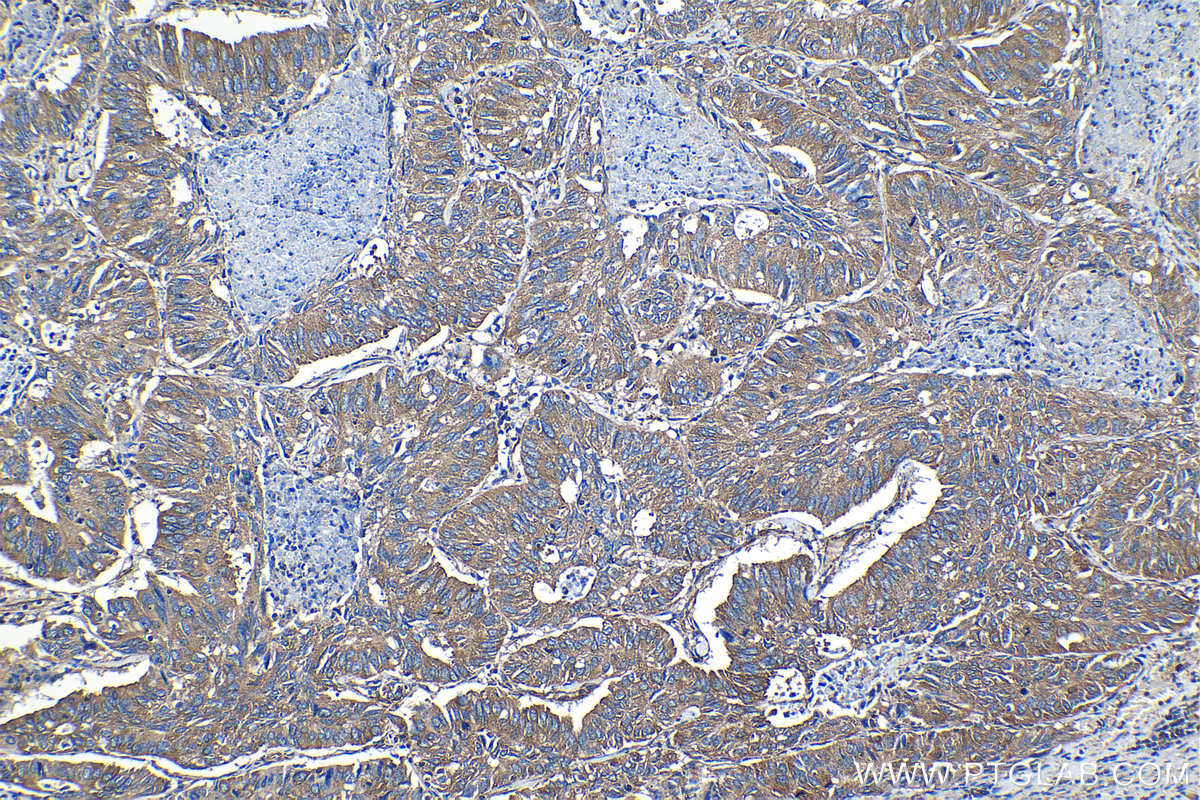 Immunohistochemical analysis of paraffin-embedded human lung cancer tissue slide using KHC1273 (AP2A1 IHC Kit).