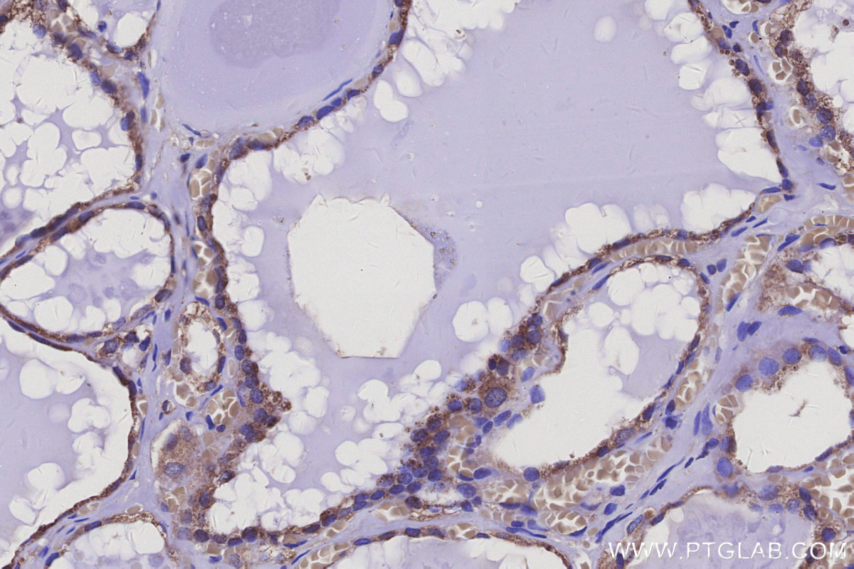Immunohistochemical analysis of paraffin-embedded human thyroid cancer tissue slide using KHC3134 (AP3B1 IHC Kit).