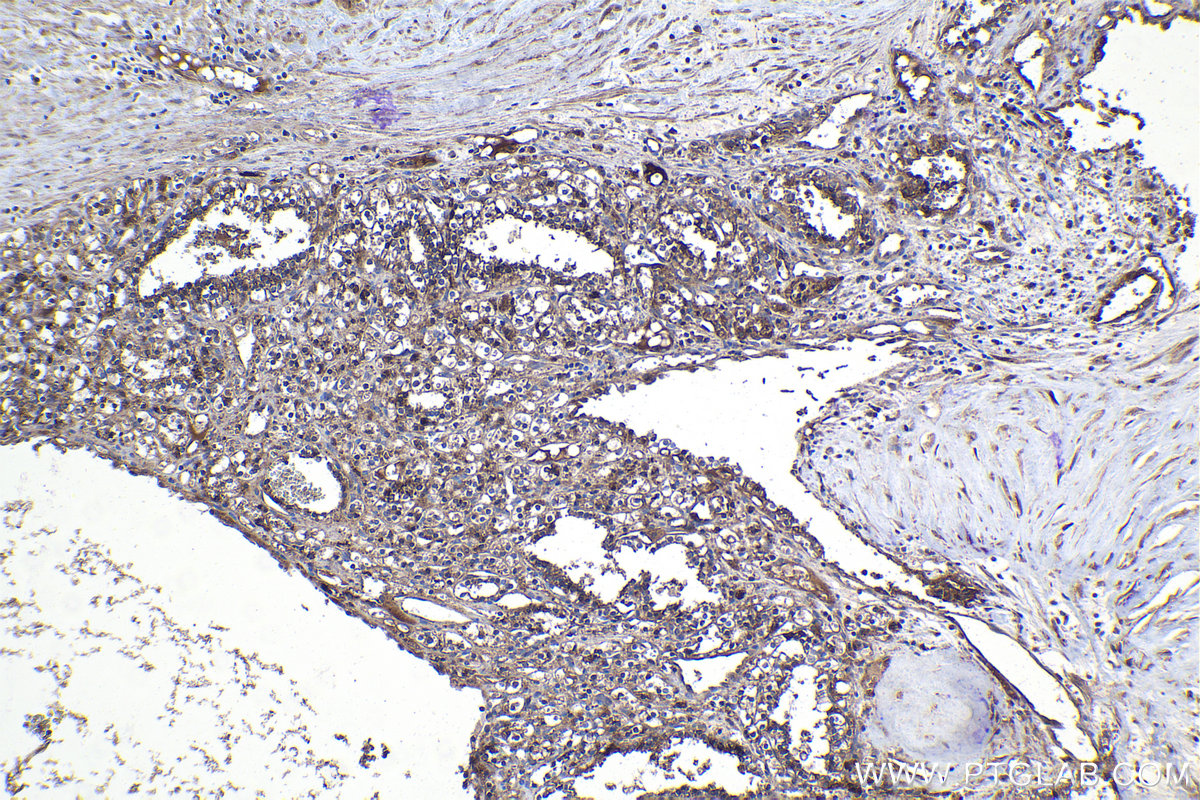 Immunohistochemical analysis of paraffin-embedded human renal cell carcinoma tissue slide using KHC1114 (APLP2 IHC Kit).