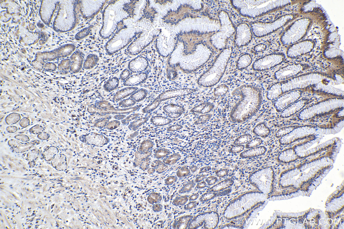 Immunohistochemical analysis of paraffin-embedded human stomach cancer tissue slide using KHC1114 (APLP2 IHC Kit).