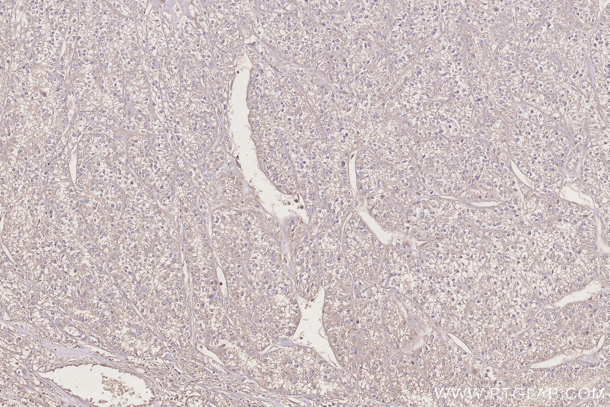 Immunohistochemical analysis of paraffin-embedded human renal cell carcinoma tissue slide using KHC3245 (APOA4 IHC Kit). Immunohistochemical analysis of paraffin-embedded human renal cell carcinoma tissue slide using KHC3245 (APOA4 IHC Kit).