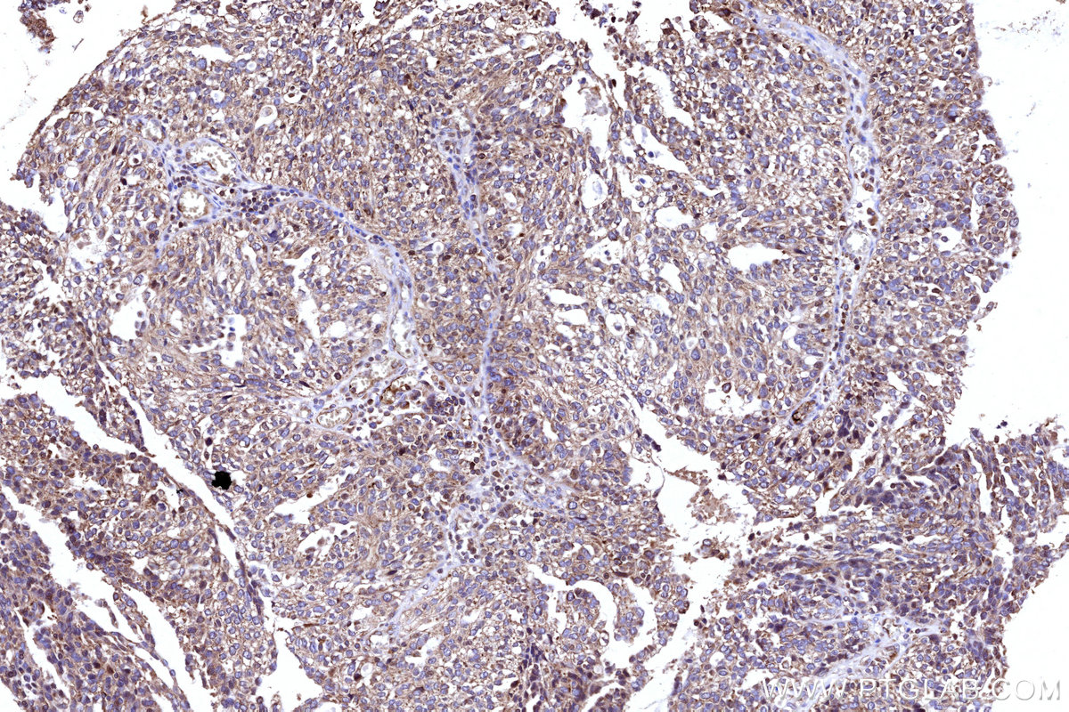 Immunohistochemical analysis of paraffin-embedded human ovary cancer tissue slide using KHC3167 (APOB IHC Kit).