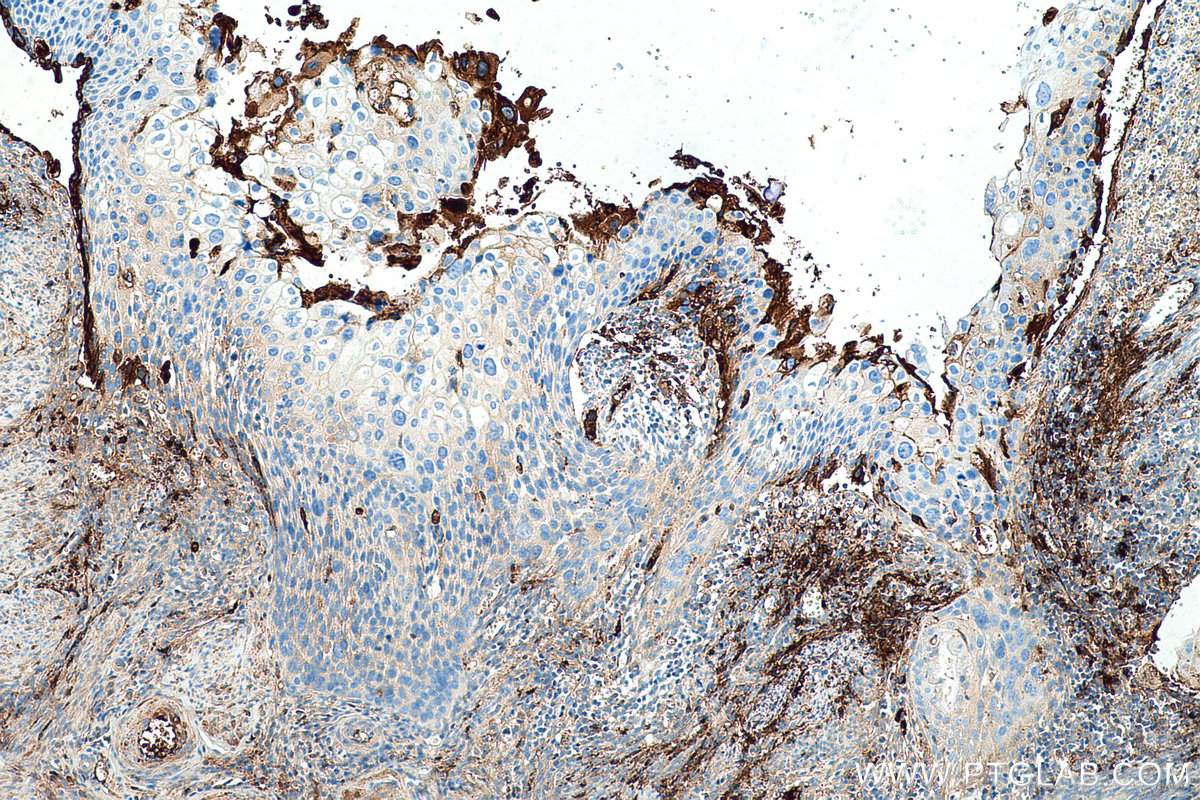Immunohistochemical analysis of paraffin-embedded human cervical cancer tissue slide using KHC0492 (APOC1 IHC Kit).