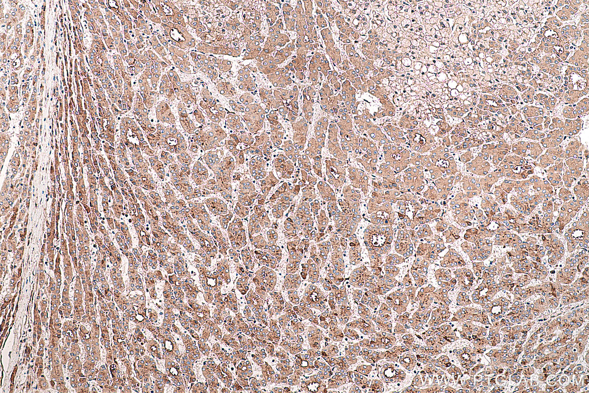 Immunohistochemical analysis of paraffin-embedded human liver cancer tissue slide using KHC0382 (APOH IHC Kit).
