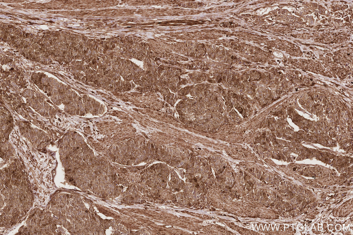 Immunohistochemical analysis of paraffin-embedded human stomach cancer tissue slide using KHC2854 (APOL2 IHC Kit).