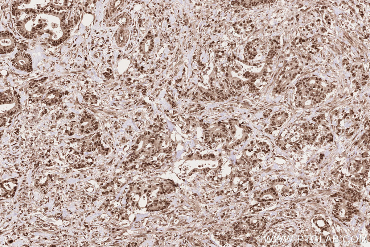 Immunohistochemical analysis of paraffin-embedded human rectal cancer tissue slide using KHC2617 (APTX IHC Kit).