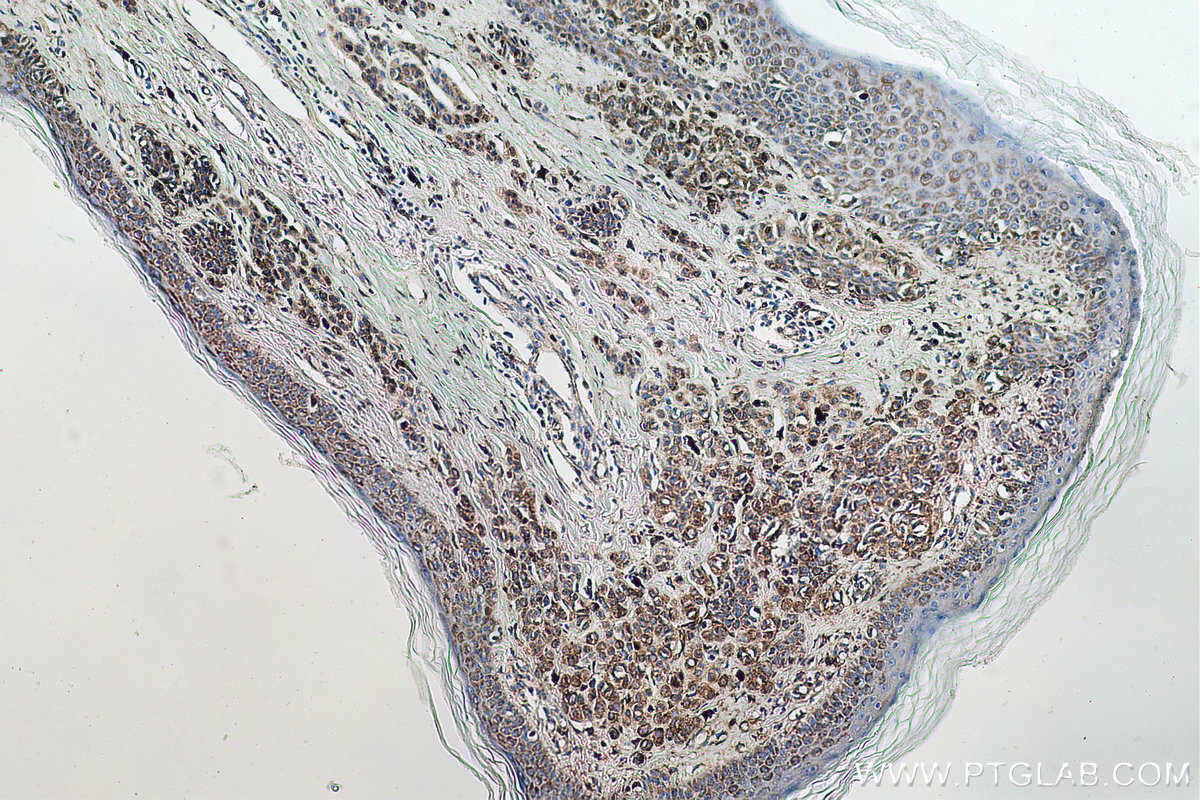 Immunohistochemical analysis of paraffin-embedded human malignant melanoma tissue slide using KHC0757 (ARC IHC Kit).