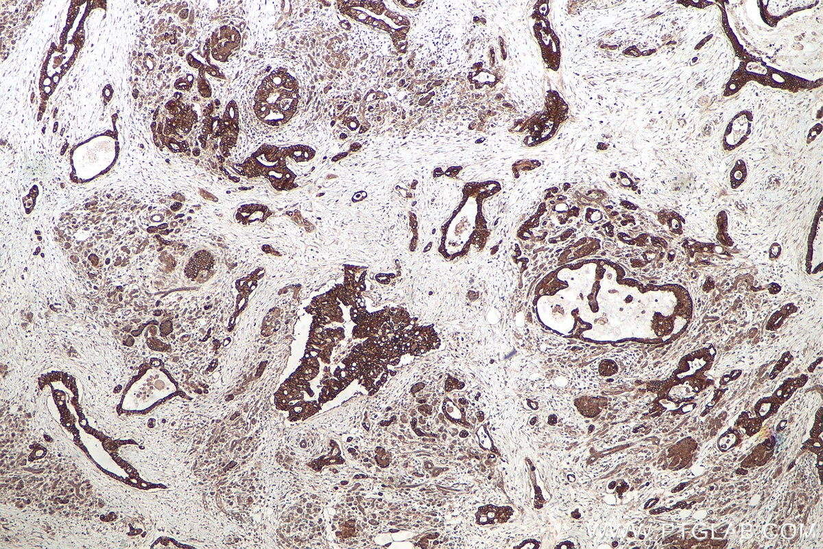 Immunohistochemical analysis of paraffin-embedded human pancreas cancer tissue slide using KHC0712 (ARF1 IHC Kit).