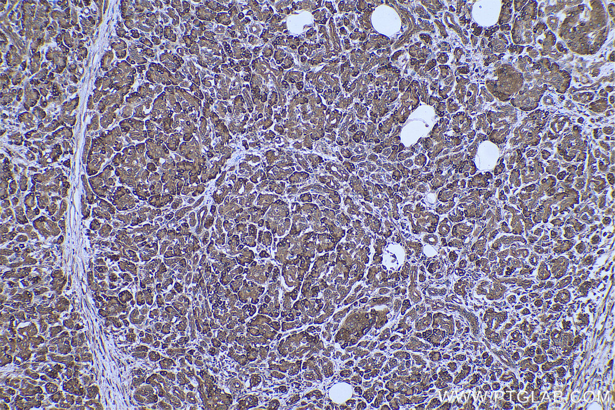 Immunohistochemical analysis of paraffin-embedded human pancreas cancer tissue slide using KHC0721 (ARF4 IHC Kit).