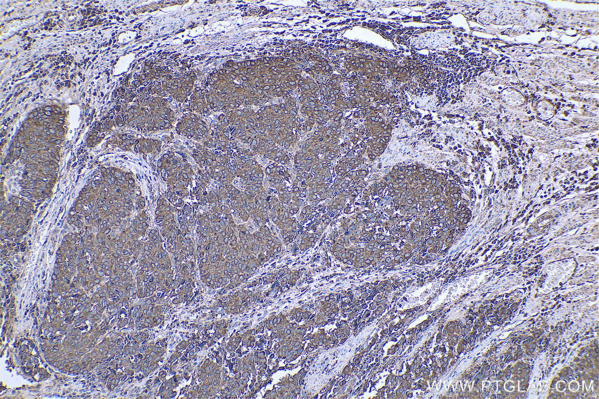 Immunohistochemical analysis of paraffin-embedded human stomach cancer tissue slide using KHC0721 (ARF4 IHC Kit).