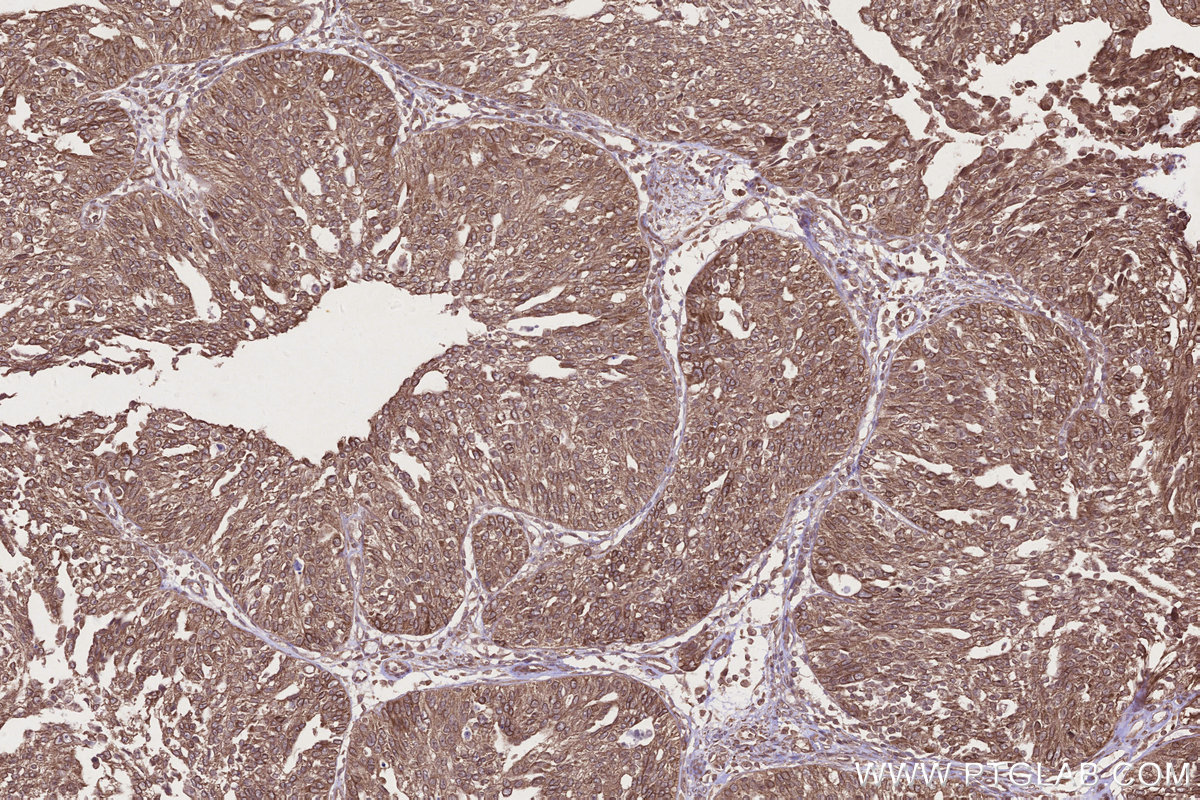 Immunohistochemical analysis of paraffin-embedded human ovary cancer tissue slide using KHC2679 (ARFGAP2 IHC Kit).