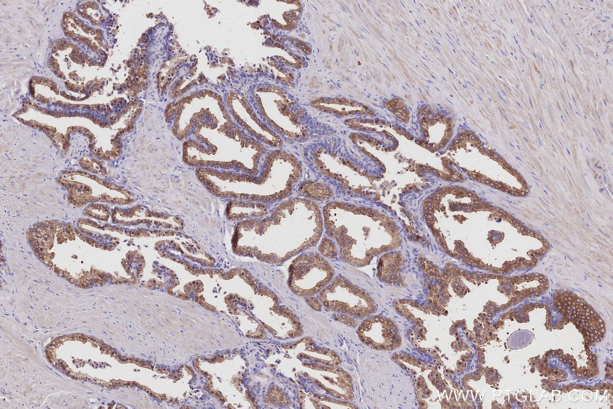 Immunohistochemical analysis of paraffin-embedded human prostate hyperplasia tissue slide using KHC2934 (ARFGAP3 IHC Kit).